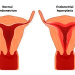 Hiperplasia endometrial 2022