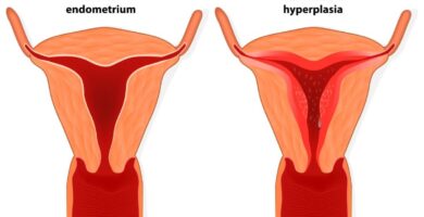 Hiperplasia endometrial 2022