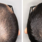 Tratamientos efectivos contra la alopecia androgénica Mesoterapia con Minoxidil