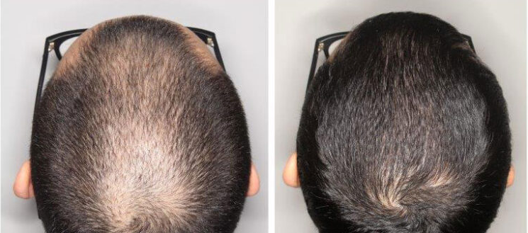 Tratamientos efectivos contra la alopecia androgénica Mesoterapia con Minoxidil